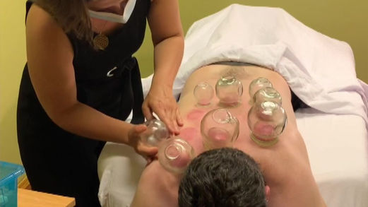 Cupping for Back & Shoulder Pain